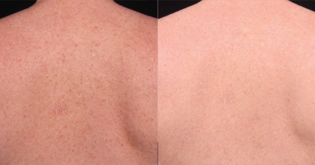 Scition Laser Treatment Before and After
