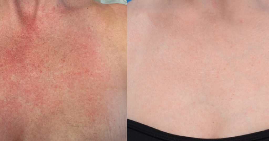 Scition Laser Treatment Before and After